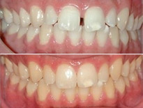 caso invisalign ortodoncia bilbao 0212
