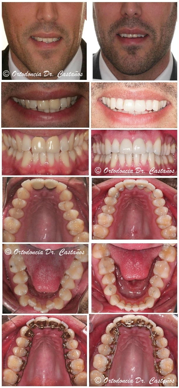 Caso resuelto con ortodoncia lingual en Castaños