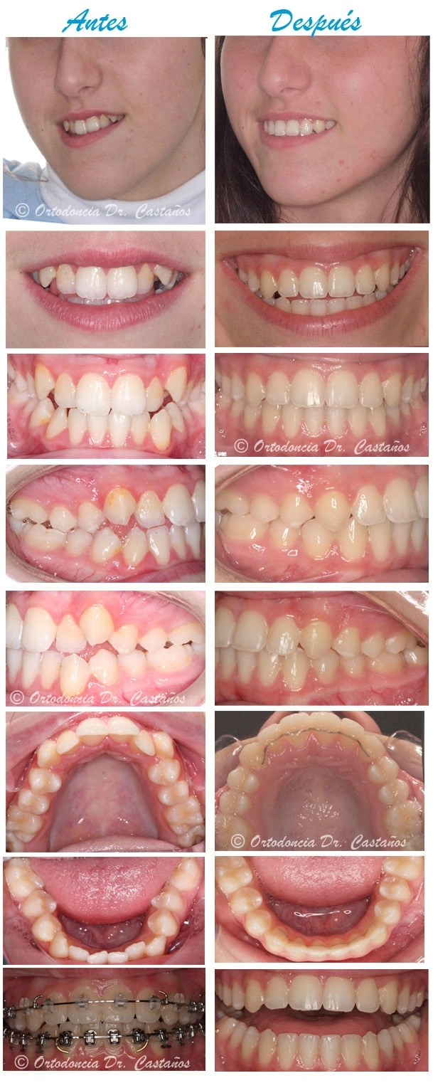 Clase III con dentición definitiva