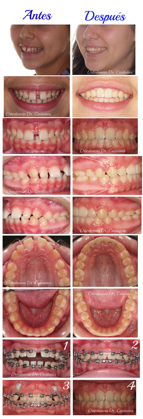 Caso resuelto con periodoncia y ortodoncia