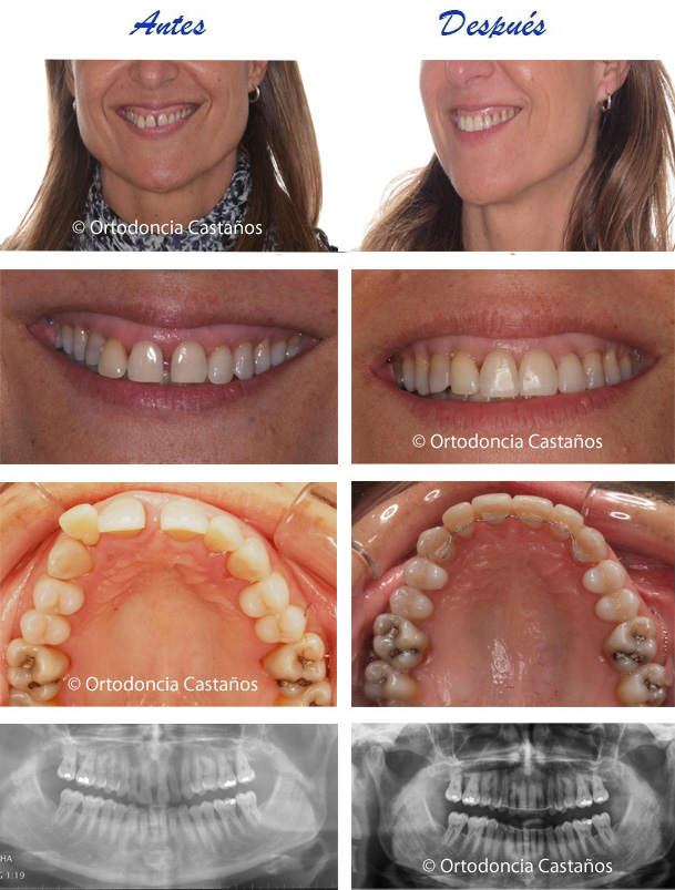Paciente periodontal con movilidad dental