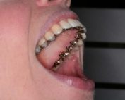 5 Ortodoncia Lingual 300x200 1