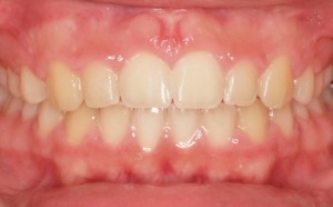 Tratamiento del frenillo con ortodoncia y periodoncia