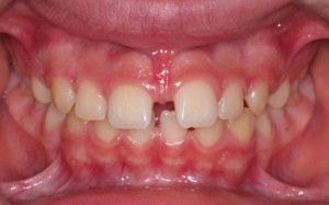 Tratamiento del frenillo con ortodoncia y periodoncia