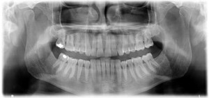 ¿Para qué sirven las radiografías que me piden antes de iniciar el tratamiento de ortodoncia?