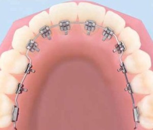 Estoy pensando en hacerme un tratamiento de ortodoncia lingual, ¿es igual de eficaz que un tratamiento de brackets convencional?