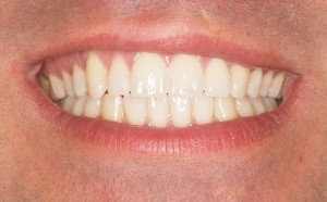 Tengo los dientes superiores e inferiores salidos hacia afuera. ¿Hay algún tratamiento para arreglarlos y que sea lo más estético posible?