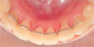 ¿Después del tratamiento de Ortodoncia cuanto tiempo es necesaria la retención o el mantenimiento  y cómo es?