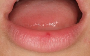 Úlceras y aftas: Tengo molestias en la boca
