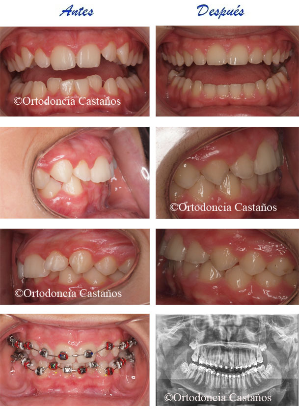 Ortodoncia Infantil: dientes amontonados