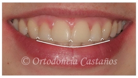 2ª Opinión para un tratamiento de ortodoncia que NO-SE-VE