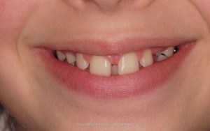 Frenillo y separación de los dientes