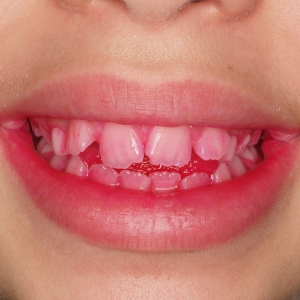 ¿A qué edad conviene comenzar un tratamiento de ortodoncia?
