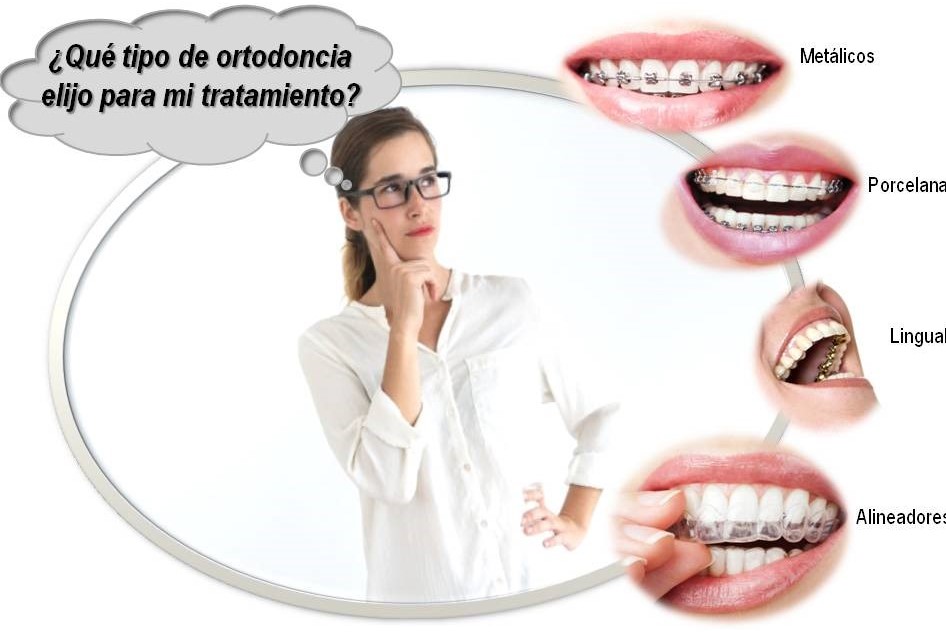 Tipos de ortodoncia ¿Cuál conviene más?