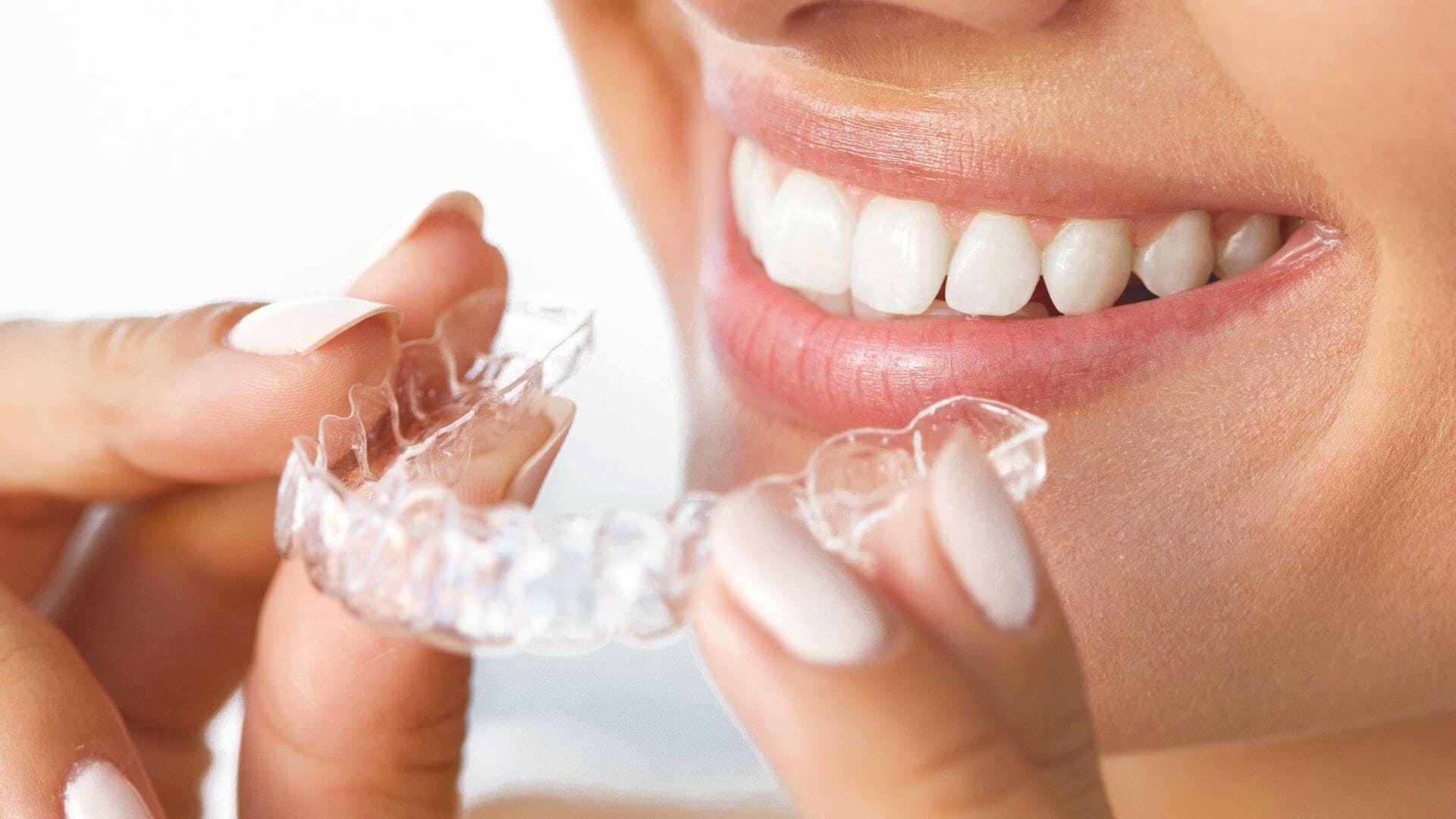 ¿Qué pasa después de la ortodoncia? La fase de retención