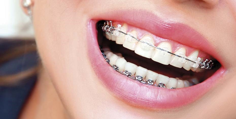 Tipos de ortodoncia ¿Cuál conviene más?