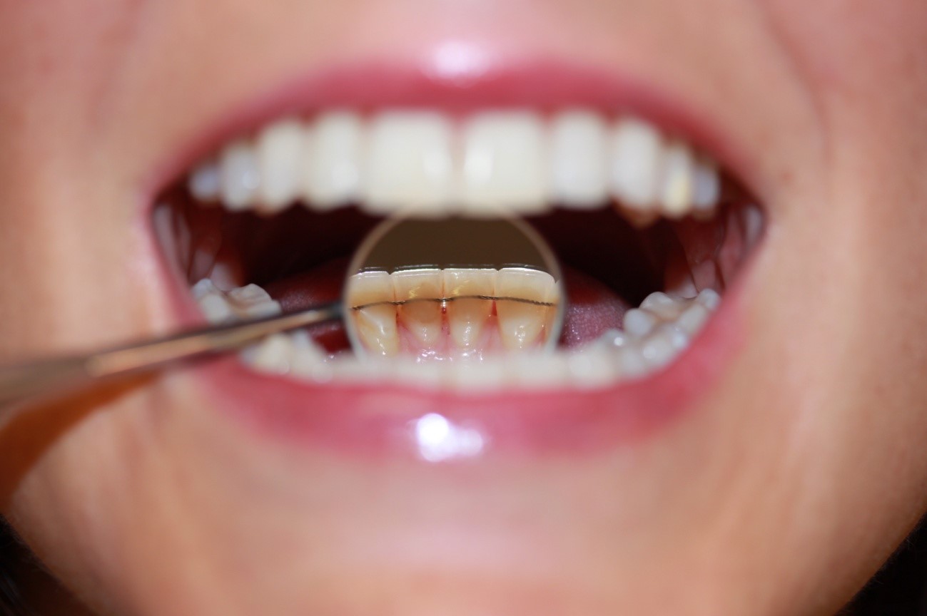 ¿Qué pasa después de la ortodoncia? La fase de retención