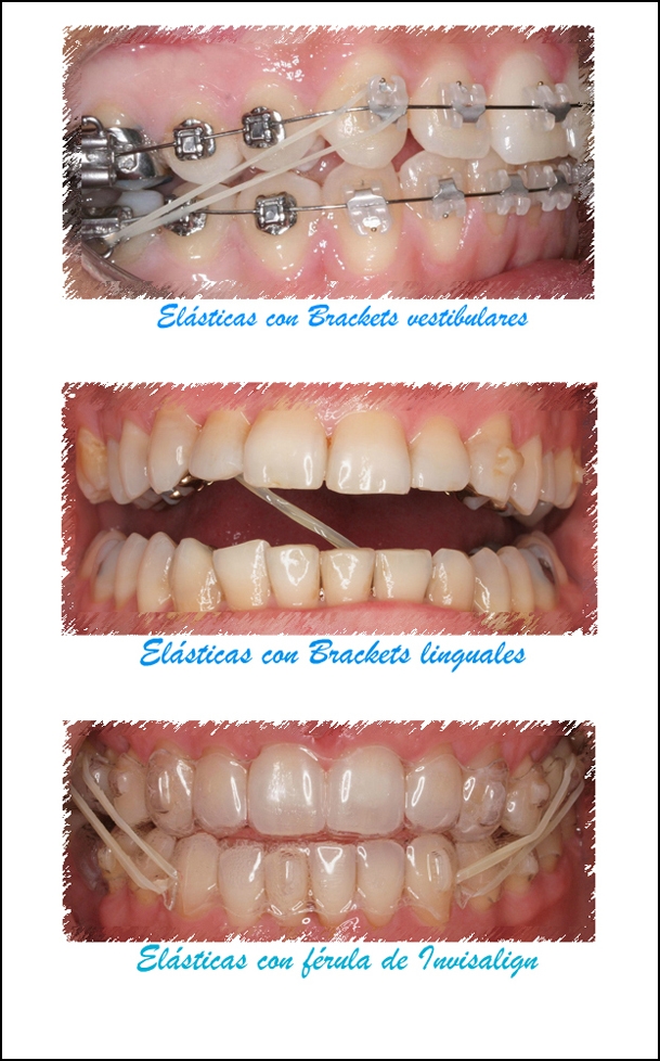 cuidado elasticos ortodoncia castanosb