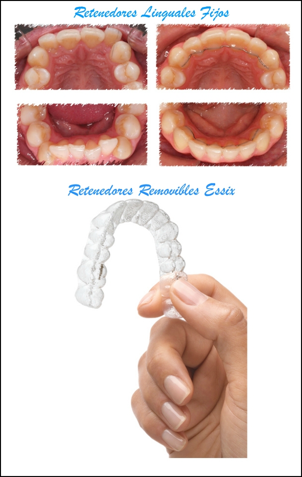 cuidados retenedores ortodoncia castanos