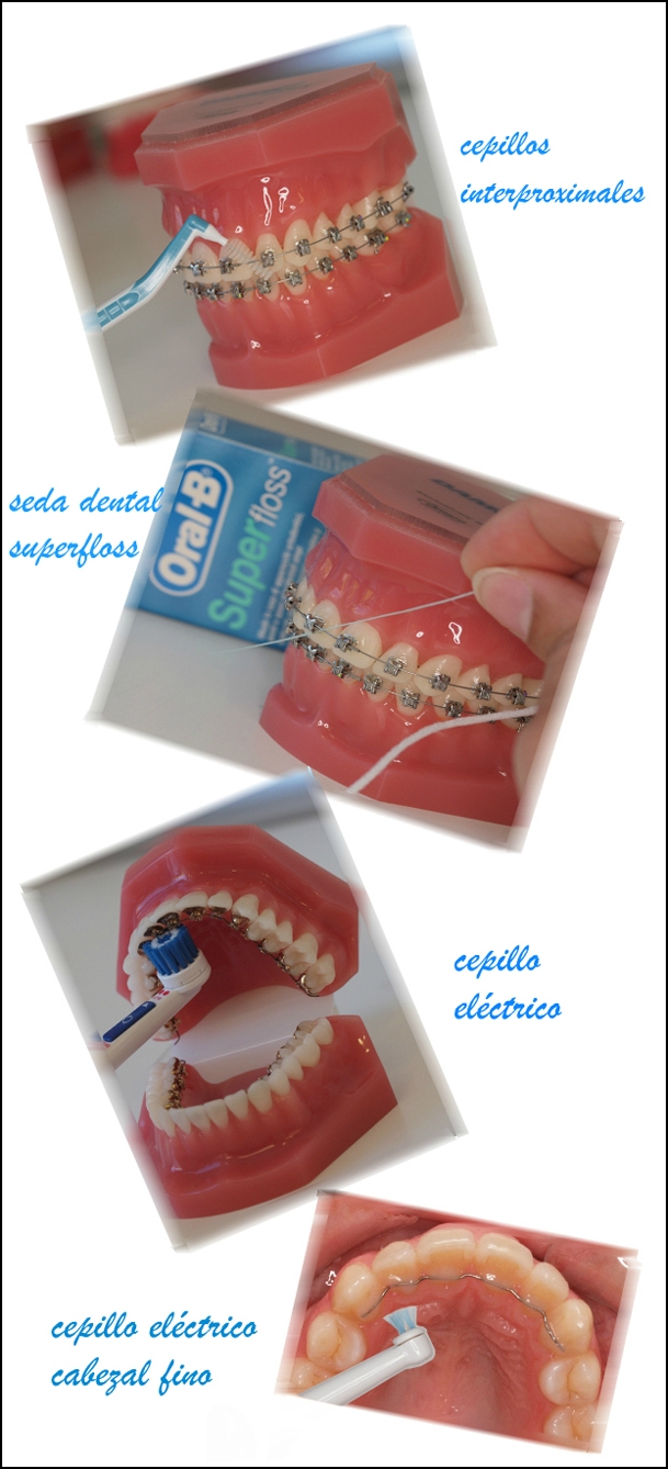 higiene mantenimento ortodoncia castanos