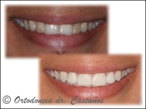 Casos resueltos con ortodoncia multidisciplinar en Ortodoncia Castaños