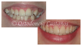 ortodoncia bilbao trat1