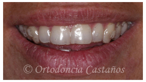 ortodoncia bilbao trat3