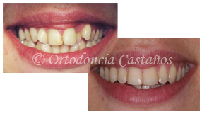 ortodoncia bilbao trat4