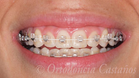 ortodoncia bilbao trat5