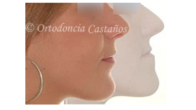 ortodoncia bilbao trat6