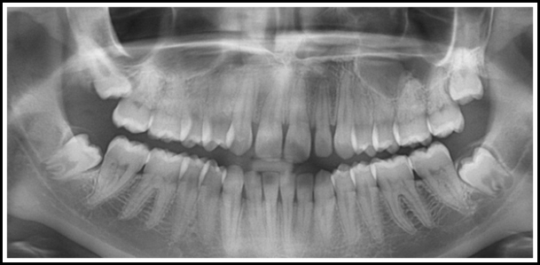 tereceros molares ortodoncia castanos