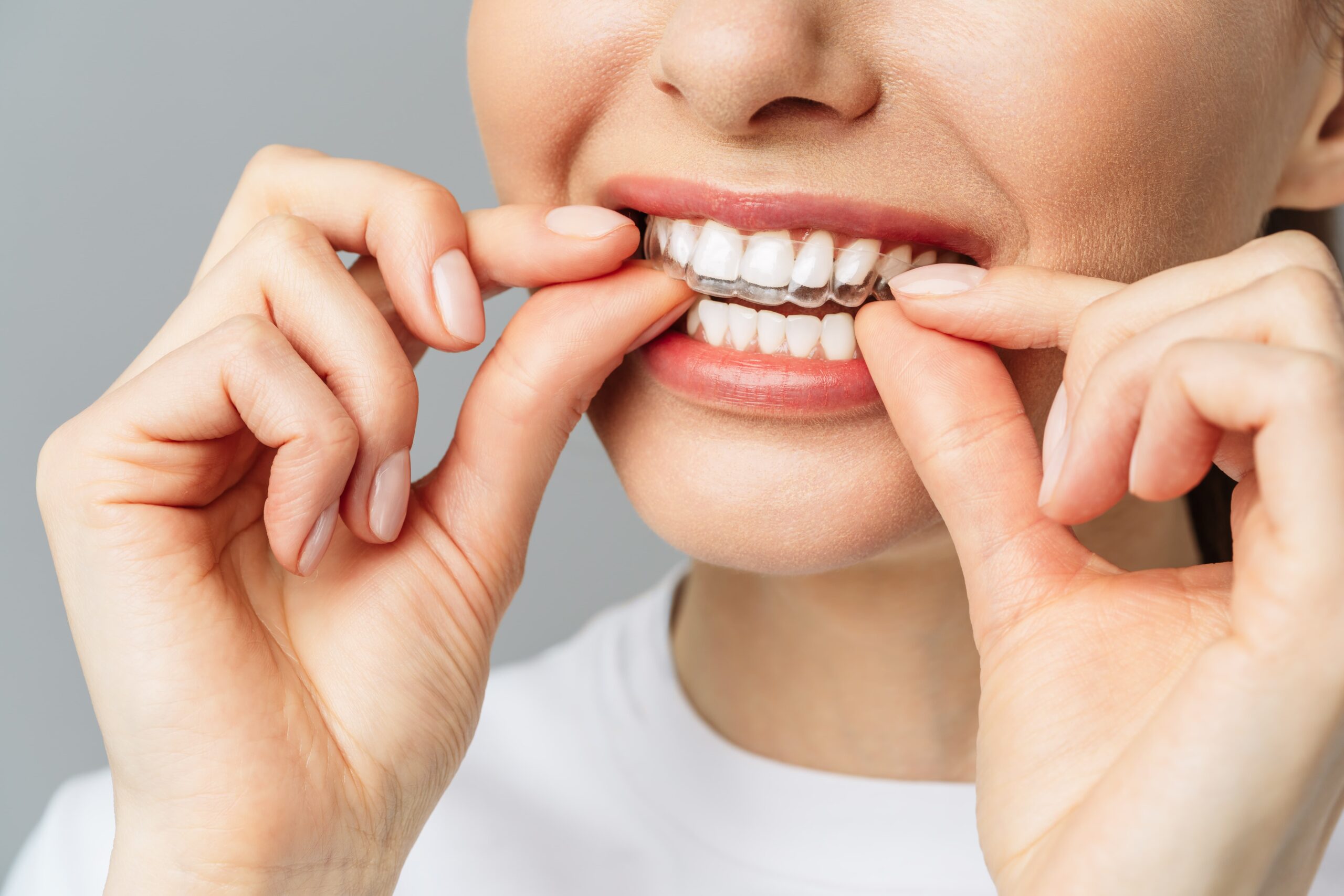 ¿Qué es Invisalign? La ortodoncia invisible que revoluciona tu sonrisa