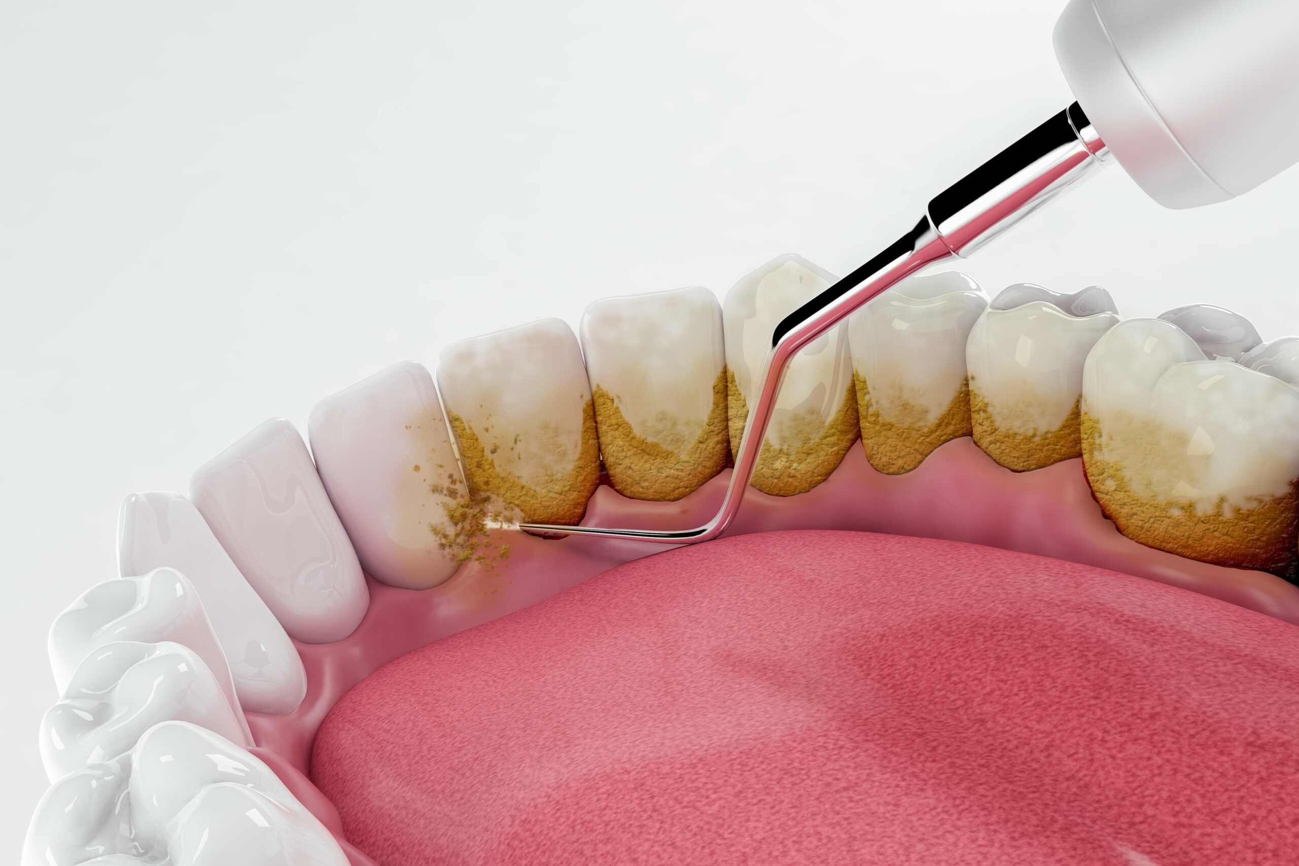 Diferencias entre Palca y Sarro dental