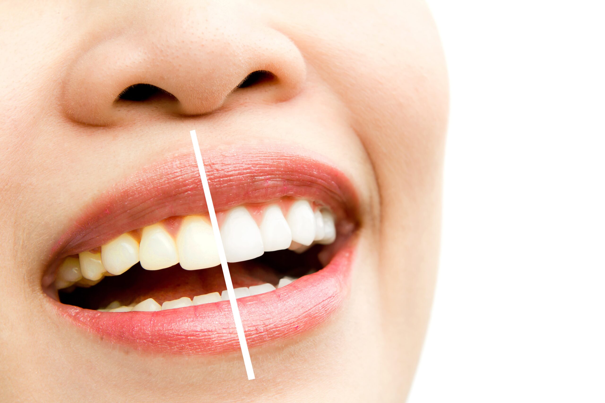 Consejos para mantener tu blanqueamiento dental a largo plazo