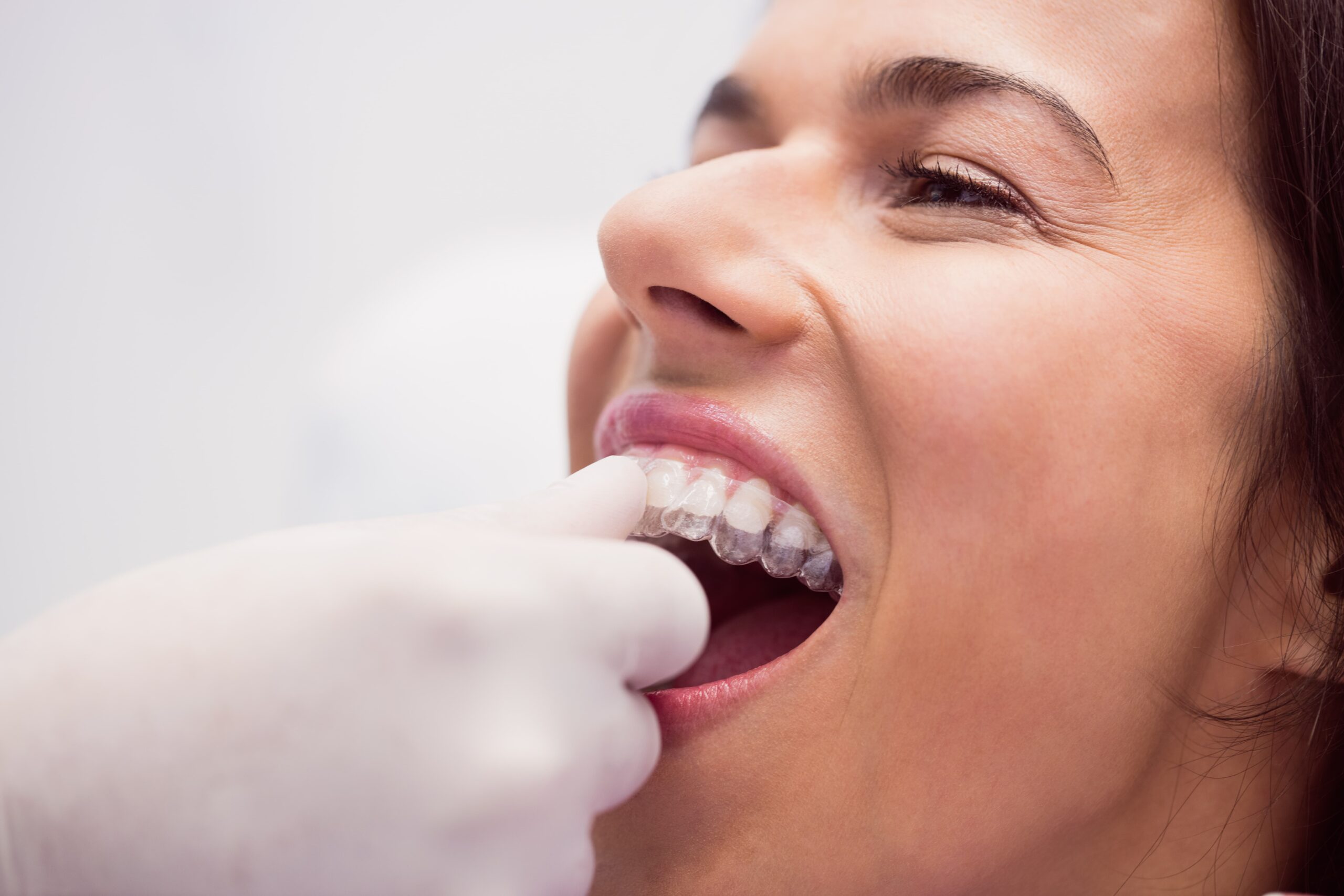 Cómo funciona la tecnología Invisalign? ¡El tratamiento más avanzado para  alinear tus dientes!